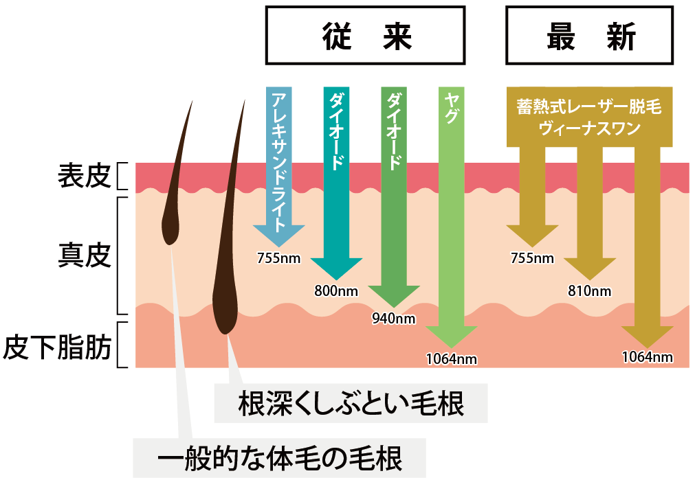男性医療脱毛 ヴィーナスワン 全身（顔・VIO込み）※初診料込 医療脱毛の機械を比較してみた！スプレンダーXとヴィーナスワン