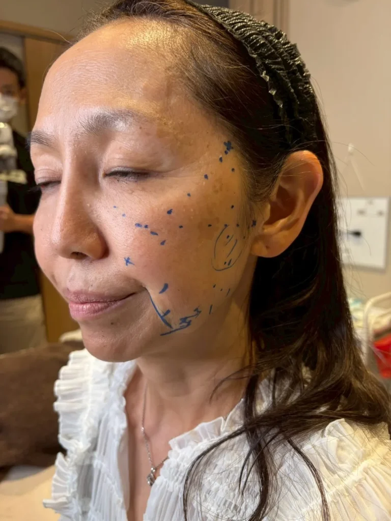 マーキングの様子