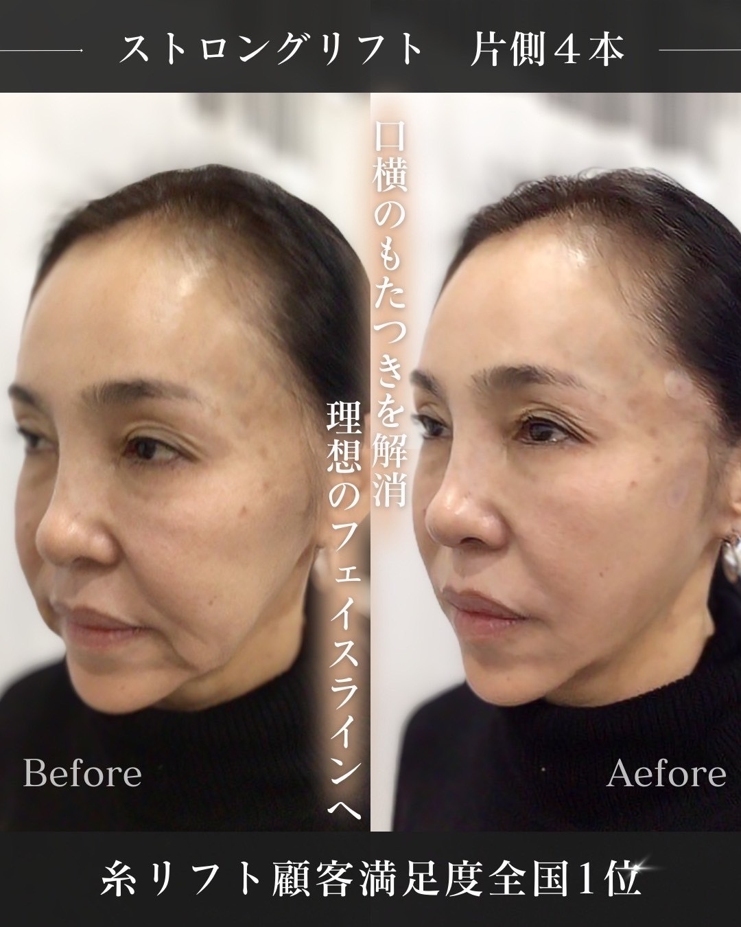 糸リフト 症例写真