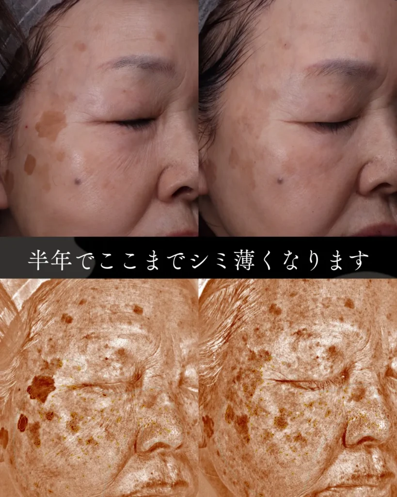 半年でここまでシミ薄くなります。