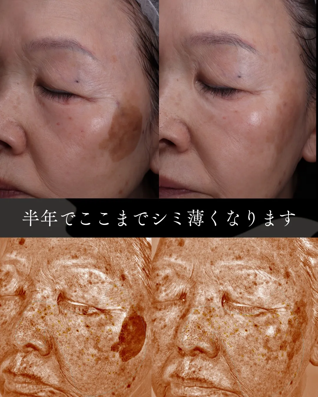 半年でここまでシミ薄くなります。2