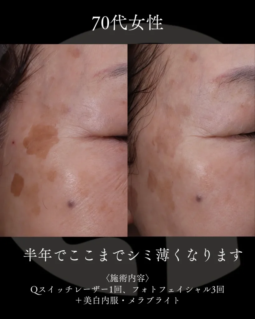 半年でここまでシミ薄くなります。4
