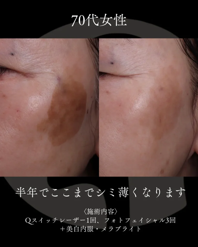 半年でここまでシミ薄くなります。3
