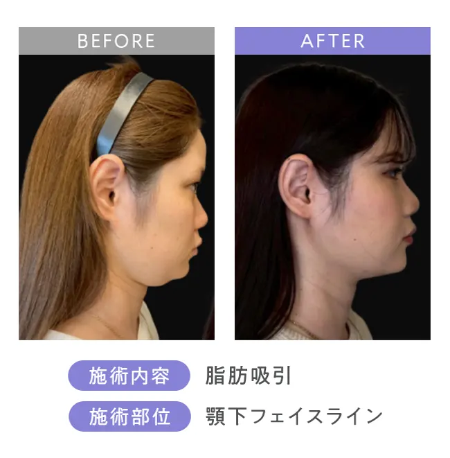 脂肪吸引・顎下フェイスライン2