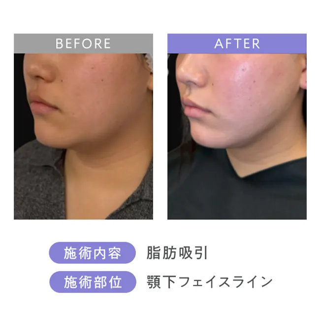 脂肪吸引・顎下フェイスライン3