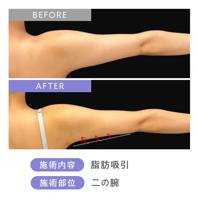 脂肪吸引・二の腕