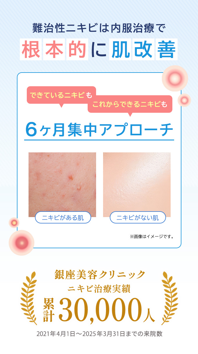 当院のニキビ治療実績は累計30,000人